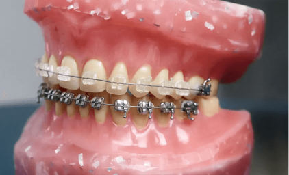 Aparate dentare fixe