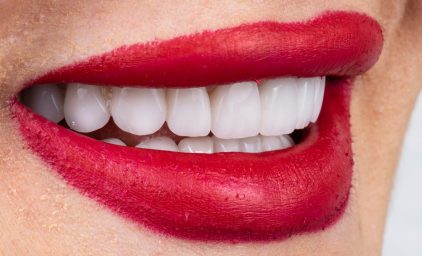 before and after picture after fixing 20 unit emax press ceramic veneers